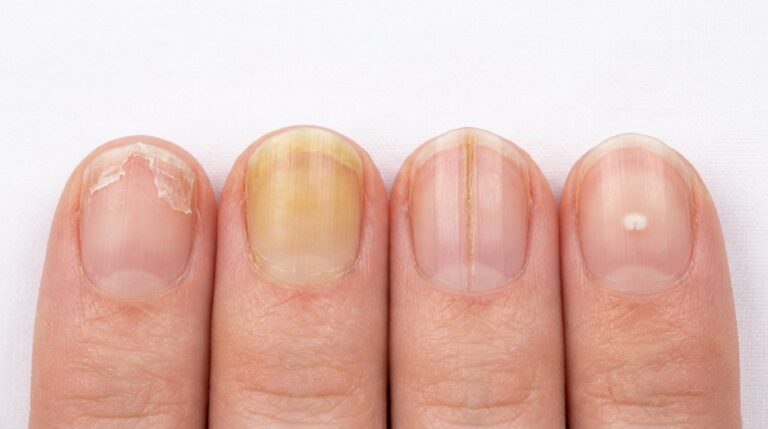 Extreme close-up of four fingernails each showing a different common nail problem including peeling yellowing ridges and white spots